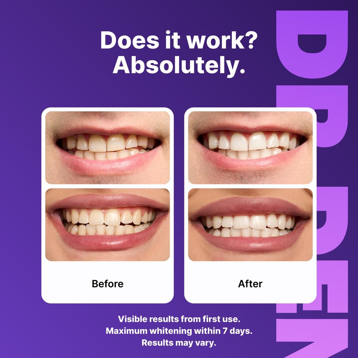 Purple Teeth Whitening Strips - 7/21 Whitening Sessions - Safe for Enamel - Non Sensitive Teeth Whitening - Peroxide-Free